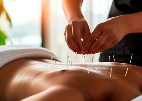 Benefícios da acupuntura para a saúde